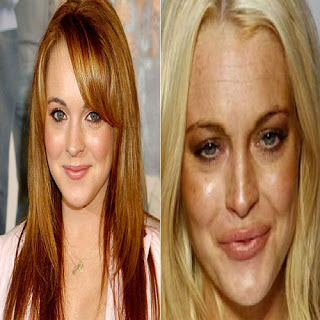 fotos-de-famosas-que-ja-fizeram-botox