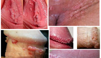 Cara Mengatasi Hpv