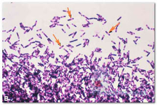 Continued. B. Gramstained Clostridium difficile bacteria, revealing subterminal spores (the light areas within the cells). C. difficile causes a diarrheal disease. (Courtesy of Dr. Gilda Jones and the CDC.)