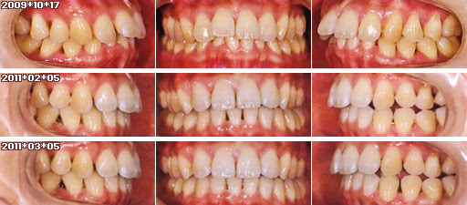 歯列矯正：定期検診その7