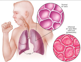 Pneumonia atau Radang Paru Paru