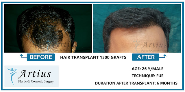 Hair transplant in Navi Mumbai