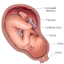 Deslocamento prematuro da placenta