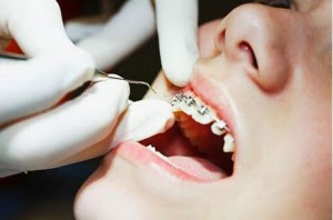 Niềng răng một hàm là gì?