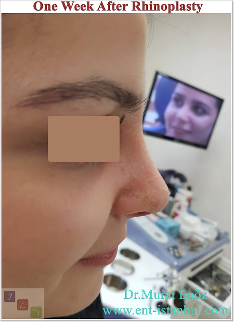 One Week After Rhinoplasty,7 Days After Nose Job, Recovery After Nose Aesthetic Surgery in Istanbul