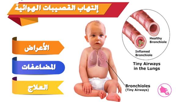 إلتهاب القصيبات الهوائية عند الرضع (bronchiolites) الاعراض المضاعفات و العلاج