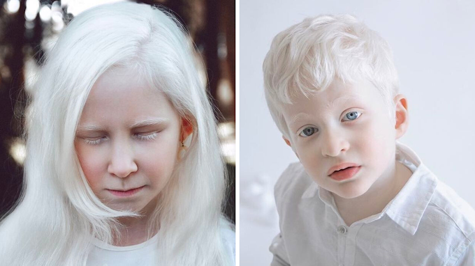 Photographer Yulia takes photos of people with albinism to show how beautiful and unique they are.