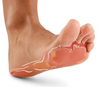 Is athlete's foot contagious | Vesicular athlete's foot vs Moccasin athlete's foot