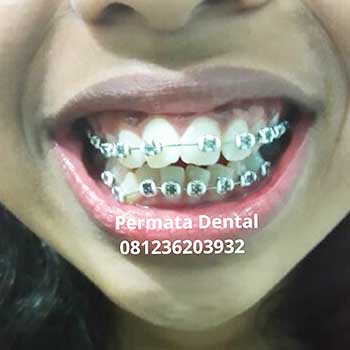 Ahli Gigi Bali Permata Dental Pasang Behel  Bracket 