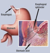 Risk for Ineffective Tissue Perfusion - NCP Gastritis