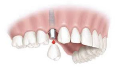 Trồng răng sứ đẹp bền theo công nghệ chuẩn quốc tế