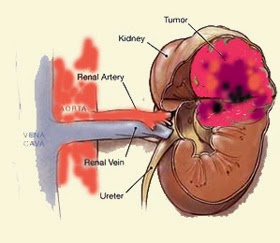 Gejala dan Penyebab Kanker Ginjal
