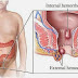 Obat Ampuh Atasi Benjolan Di Dubur Atau Anus Setelah Melahirkan