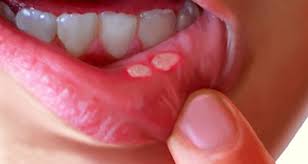 Easy solution for mouth ulcers