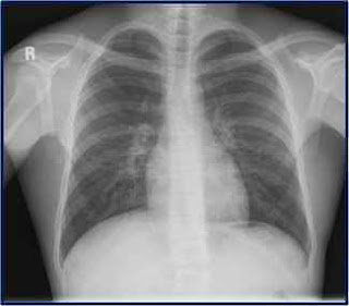 akciğer grafisi