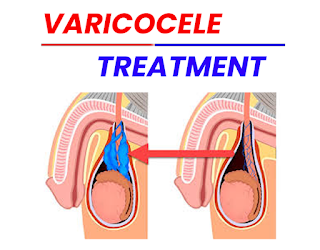 homeopathic varicocele treatment