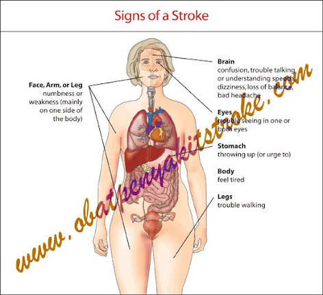 Penyakit Stroke