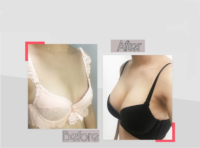 operasi payudara, operasi plastik korea, oplas korea, implan payudara, breast surgery, plastic surgery, dokter korea, konsultasi, payudara indah, operasi mudah, penyembuhan cepat, payudara besar