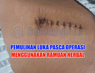 obat herbal luka pasca operasi