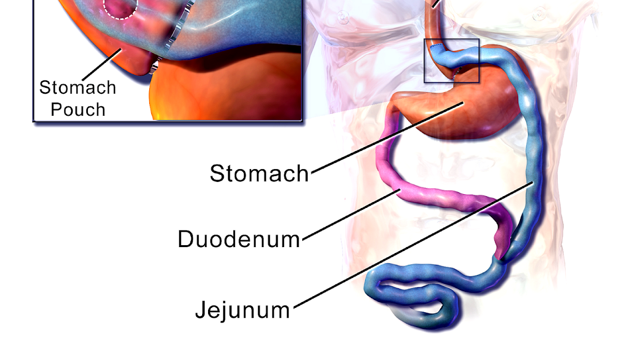 Gastric Bypass And Ulcers