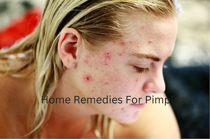 Home Remedies For Pimple