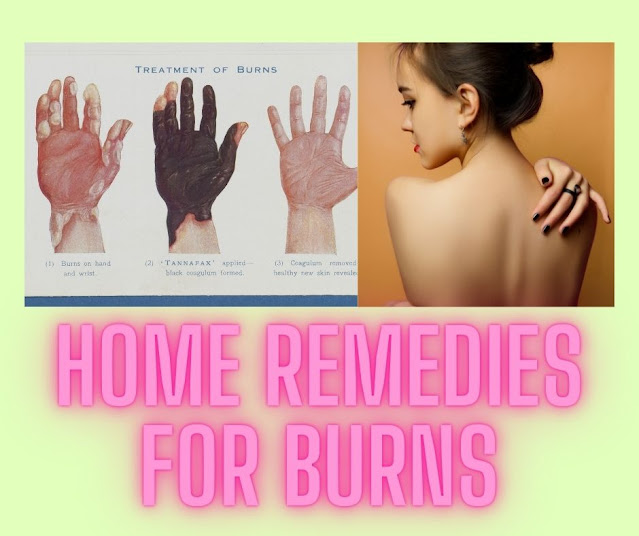 10+ Home remedies for Burns with its cause and symptoms