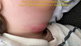 Infected Thyroglossal Duct Cyst (TGDC),Neck Abscess,Thyroglossal  fistula,Thyroglossal Duct Cyst,