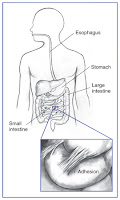 What are abdominal adhesions?