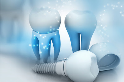 Dental Implants Brooklyn NY