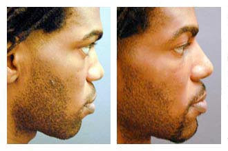 Rhinoplasty Photo