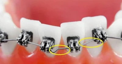 Tại sao phải thay dây cung trong niềng răng chỉnh nha?-2