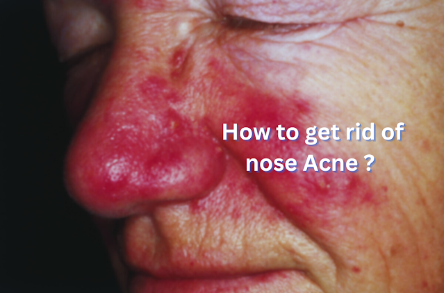 How to get rid of nose Acne