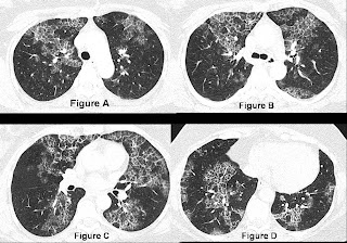 Adjuvant Chemotherapy In Admirable Pledge Stage I Non Seminomatous Germ Adjuvant Chemotherapy In Admirable Pledge Stage I Non Seminomatous Germ