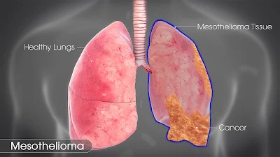 A Glimpse of Mesothelioma