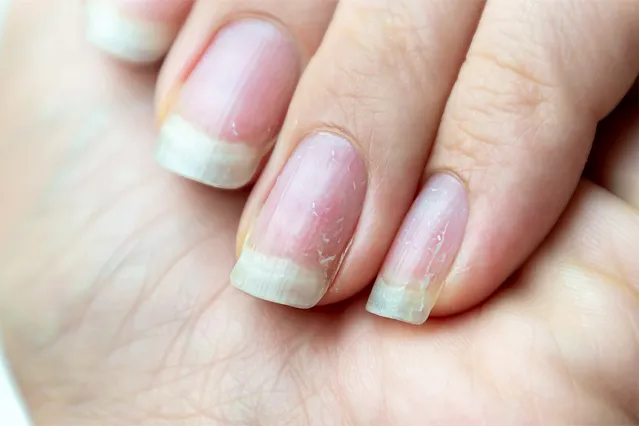 What Causes Brittle Nails and How to Fix Them
