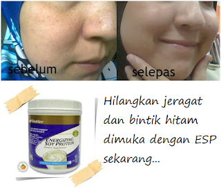 Atasi Masalah Jeragat dengan Set Jeragat Shaklee