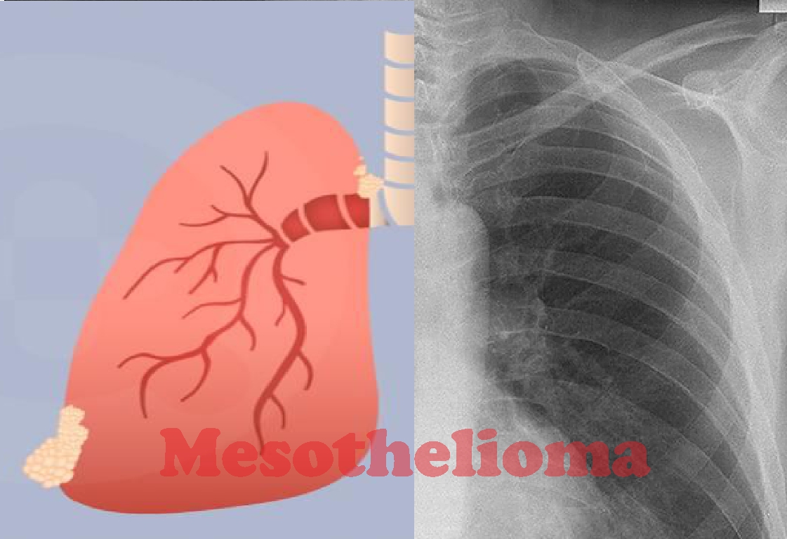 causes of mesothelioma