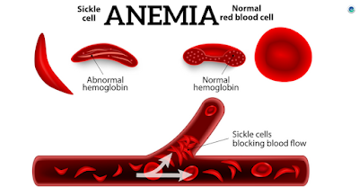 Hemoglobin-Anemia