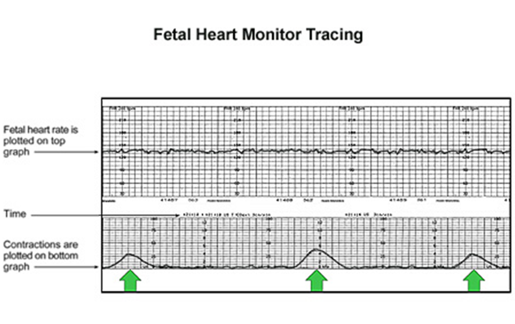 nurulnadiah: Kadar Degupan Jantung Bayi / Apakah CTG ...