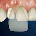 Mặt dán sứ Veneer tái tạo răng hư hỏng 