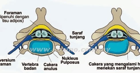 STO : : SLIP DISC ~ Skema Hidup Sihat