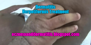 Dermatitis Herpetiformis Treatment