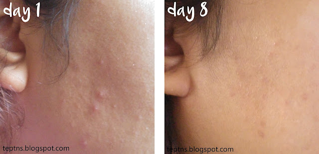 SkinGenie Acne Warrior Soap results pimple