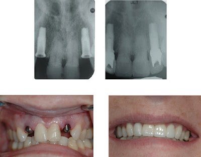 cay-ghep-rang-implant-co-tot-khong