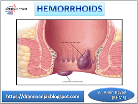 hemorrhoids type