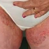 Salep Obat Gatal Gatal Selangkangan Di Apotik Resep Dokter