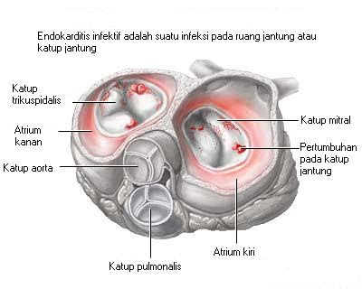 Endokarditis infektif