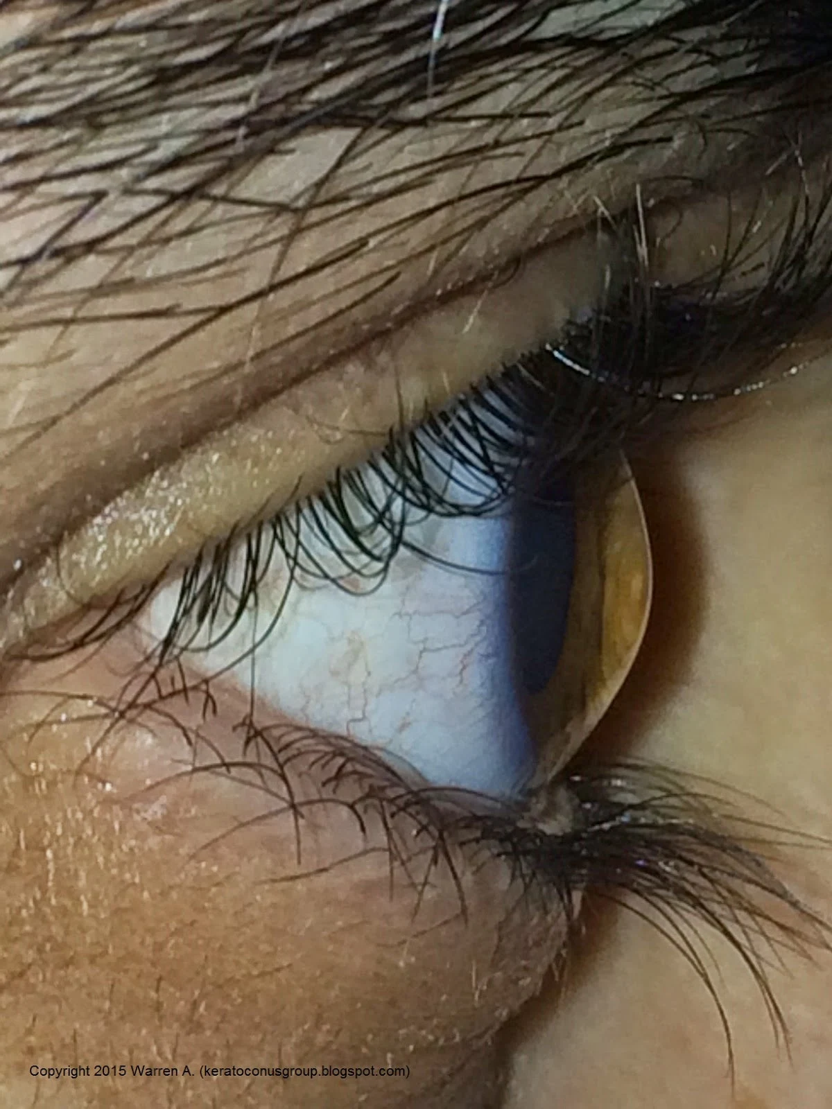 Side view of the cornea in a patient with keratoconus. Photo by Warren A., a member of our Facebook community 