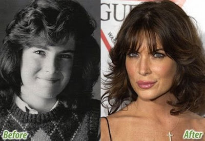 celebrity plastic surgery