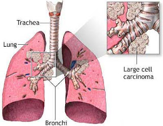 Lung cancer definition, Lung cancer prognosis, symptoms lung cancer, cancer symptoms, symptoms of cancer, small cell cancer, lung cancer smoking, lung cancer treatment, lung cancer survival, lung cancer pain